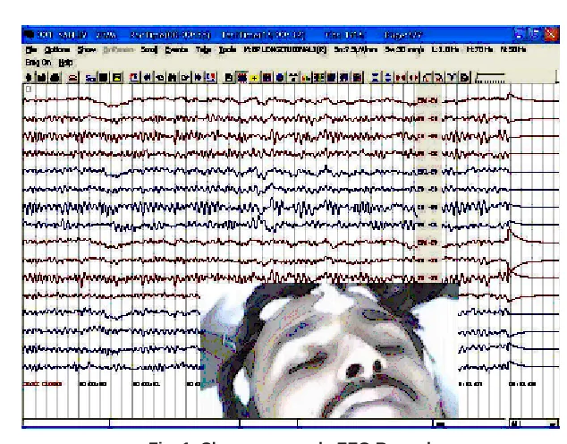 Fig. 1: Shows  a sample EEG Record