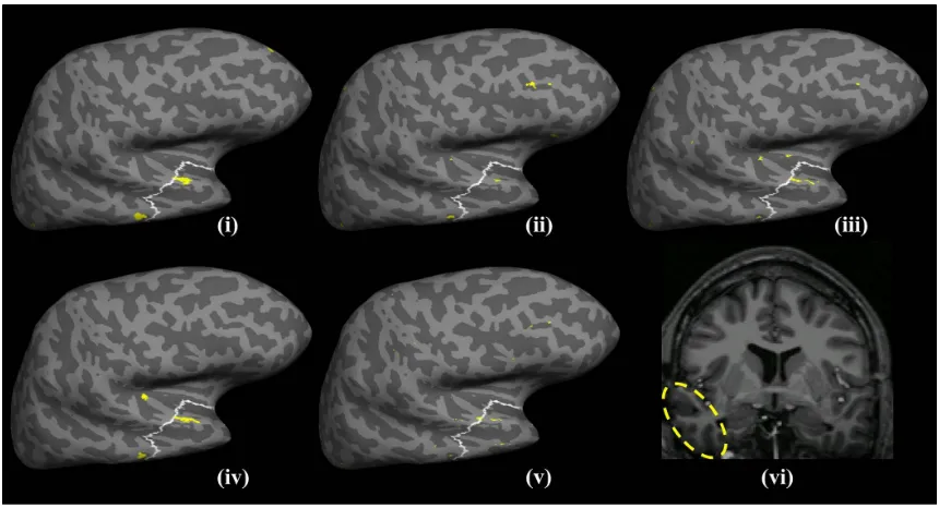 Figure 2: Detection results for NY67 using cortical thickness shown on an inﬂated model ofthe lateral cortical surface