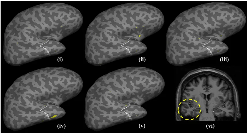 Figure 3: Detection results for NY294 based on curvature. The white outlined area repre-sents the region that was resected, while the ﬁlled yellow patches represent thedetected clusters at the ﬁrst detection threshold for both the HCRF and the z-score base