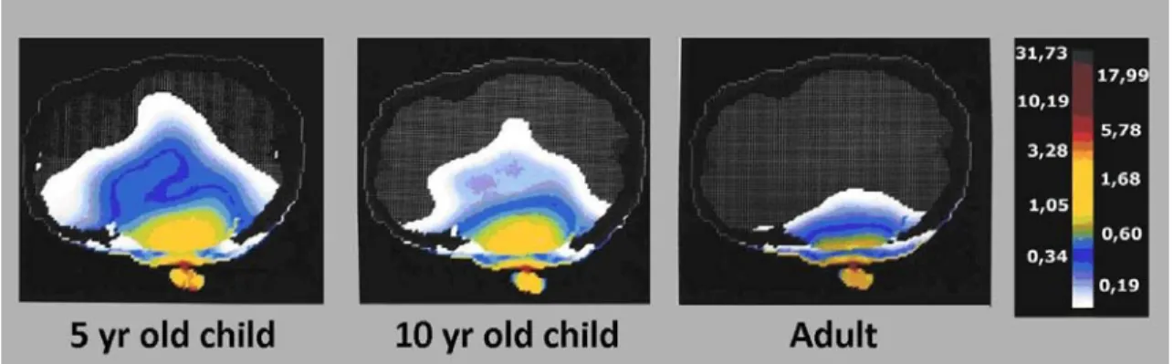Figure 1   Model estimate of the absorption of electromagnetic radiation from a cell phone based on age  (Frequency GSM 900 Mhz) (On the right, color scale showing the Specific Absorption Rate in W/kg)[1]