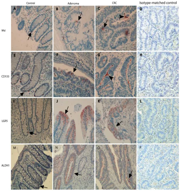 Figure 1: The presentation of stem-like markers Msi, CD133, LGR5 and ALDH1 in different stages of the adenoma- adenoma-carcinomas evaluated with IHCs