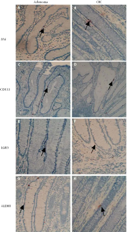 Figure 2: Changed presentation pattern of stem–like markers in the transitional crypts close to adenomas and CRCs