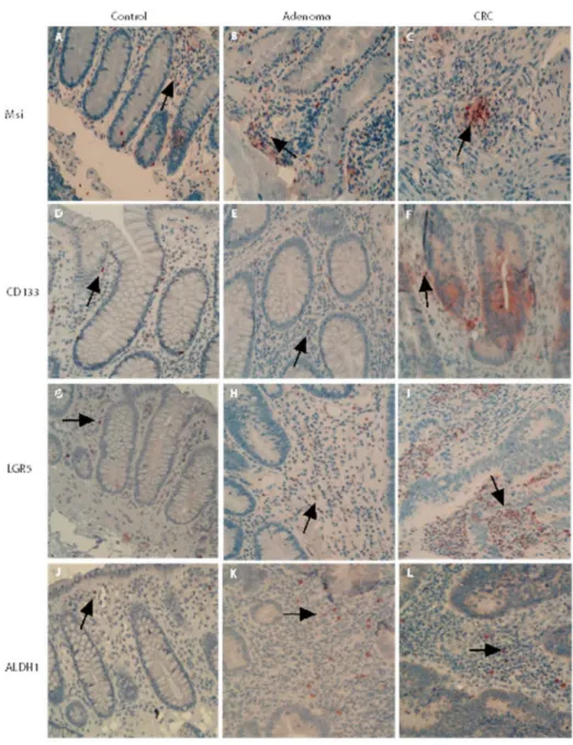 Figure 3: Mesenchymal stem-like markers in the adenomatous/cancerous tumor stroma.  The stromal cells positive for  stem-like markers were diffusely distributed and the numbers of cells positive for stem-like markers Msi, CD133, LGR5 and ALDH1  in normal l