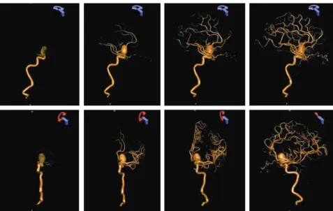 FIG 4. Four-dimensional DSA reconstruction from a 3D-DSA reconstruction performed for evaluation of an unruptured paraclinoid aneurysm.An IA injection of contrast was used for this examination
