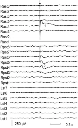 Figure 3.1: The example of an ER according to Valentin et al. [15]. To the electrodes with the ﬂat lines, a pulse is applied