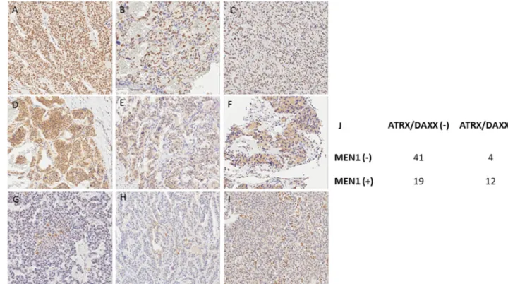 Figure 1: Immunohistochemical staining of MEN1 (A)(D)(G), ATRX (B)(E)(H), and DAXX (C)(F)(I)