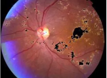 Figure 7. INPUT IMAGE WITH OPTIC DISC CIRCLED 