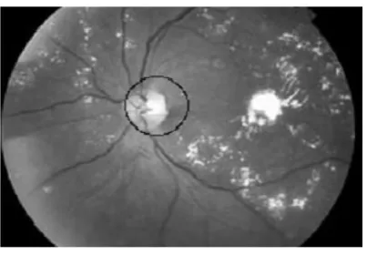 Figure 9 INPUT IMAGE WITH OPTIC DISK CIRCLED 