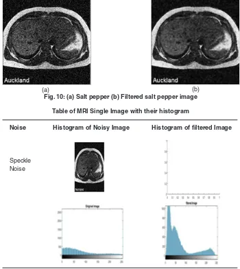 Table of MRI Single Image with their histogram