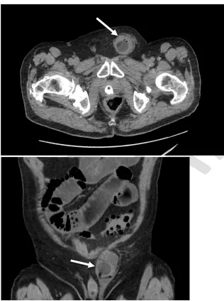 Fig. 1A, 1B. Initial computed tomography scan demonstrating a left inguinal hernia containing a portion of the urinary bladder with the Foley catheter balloon (white arrow) within the herniated segment