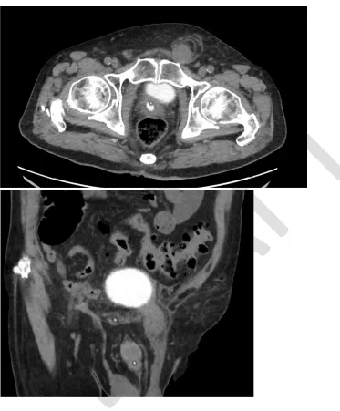 Fig. 2. Repeat computed tomography scan showing persistent incarceration of the urinary bladder and successful reduction of small bowel after bedside reduction attempted under procedural sedation
