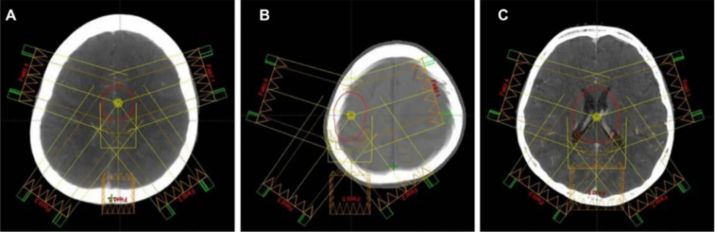 Figure 5:  Typical  target  volumes  delineated  on  pseudo-CT  scans:  (A) PTV ord , (B) PTV skull , and (C) PTV vent 
