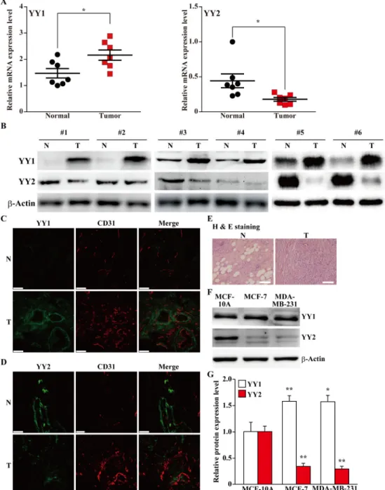 Figure 1: Distinct expression patterns of YY family in tumor tissues.  (A, B) The expression levels of YY1 and YY2 in clinical  human breast carcinoma tissues: (A) mRNA expression levels of YY1 and YY2 were examined using quantitative RT-PCR (qPCR, n = 7);