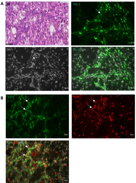 Figure 3: PD-1 expression in CM.  Representative immunohistological staining shows that: (A) PD-1 (green, membrane) is expressed  on stromal cells surrounding the primary tumor areas (white arrows); (B) staining of CD3 (green) and CD8 (red) demonstrates th