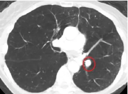 Fig (a) : CT scan showing lung nodule. 