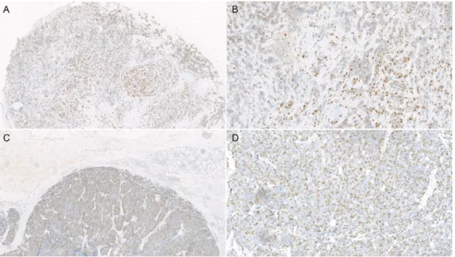 Figure 4: Microscope photographs of immunohistochemistry stain of Ki-67 expression in esophageal small cell  carcinoma: Low expression of Ki-67 (< 50%, A: ×40; B: ×200) and high expression of Ki-67 (> 50%, C: ×40; D: ×200)