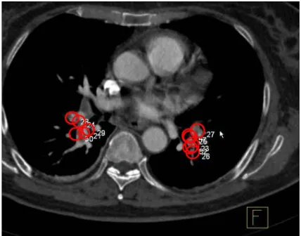 Figure 1: Two pulmonary emboli (blood clots) as they are detected by the Candidate Generationalgorithm in a CT image