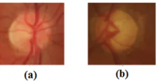 Figure 1. Eye RIM-ONE database images: (a) Normal image, (b) Glaucoma image (abnormal)