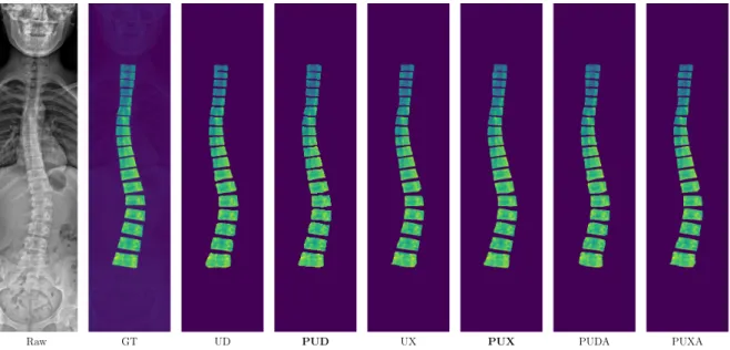 Figure 4.6: Visualization (zoomed) of the predicted vertebrae masks in a spine X-Ray shows consistent improvement by our model over all other models.