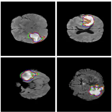 Fig. 2. Tumor contour detection using the Chan-Vese method; blue is the thresholded, binary tumor estimation of the color-spatial saliency map, red is the improved result of the active contour step, green is the ground truth tumor outline.