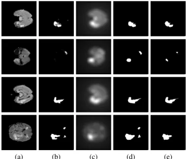 Fig. 3. Fusion of neural networks and saliency-based features, row 1-2: U- U-Net; row 3-4: WT-U-Net; (a) FLAIR image slice; (b) result of the neural network based segmentation; (c) calculated saliency map; (d) binary segmentation result achieved by the 0.5