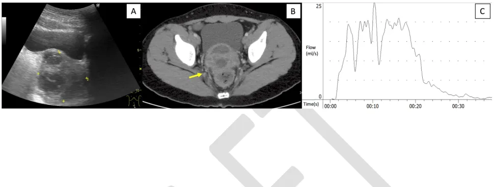 Fig. 1. (A) Abdominal sonography revealed a heterogeneous septated mass. (B) Contrast-enhanced computed tomography scan of the abdomen and pelvis revealed prostatic abscess with multiple loculations (arrow)