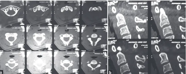 Figure 1: Magnetic resonance imaging cervical spine sagittal and axial view showing C2–C3 anterior epidural lesion which is isointense on T1‑weighted images (sagittal view a, axial view d), hyperintense on T2‑weighted images (sagittal view b, axial view e)