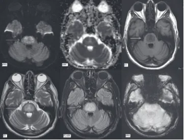 Figure 7: Magnetic resonance imaging findings on day 36. Diffusion‑weighted imaging, apparent diffusion coefficient map, T1‑weighted, T2‑weighted, fluid attenuation inversion recovery and susceptibility‑weighted imaging images (as labeled) at the level of 