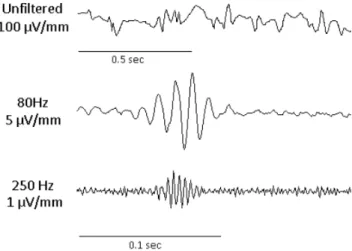 Figure 2: Example of an HFO found during intracranial EEG recording. The top trace is the unfiltered signal, the middle