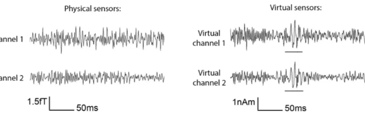 Figure 3: MEG physical sensor channels (left) and virtual sensor channels (right) of the same epoch of the same brain region for two channels, filtered with an 80 Hz high pass filter