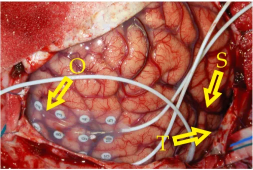 Figure 5: Placement of ECoG electrodes for patient 9. The electrode grid that is shown on the bottom left side consists
