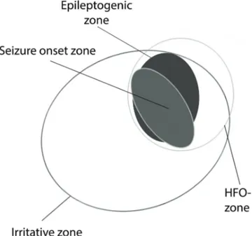Figure 1: Different zones that can be used to estimate the epileptogenic zone in focal epilepsy