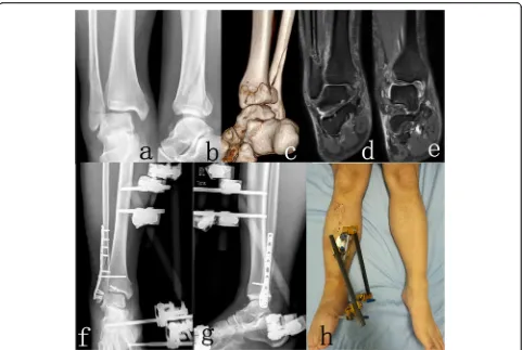Fig. 1 Imaging studies of a 24 years patient with SER IV ankle fractures (AO/OTA classification 44-B3.1) underwent ORIF with TEF
