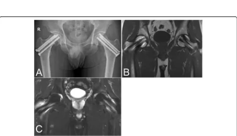 Fig. 1 a Initial radiograph showing bilateral femoral neck fracture (arrows). The osteosclerotic lesion was observed at the right acetabulum(arrowheads)