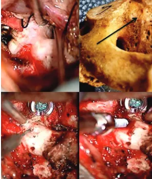 Figure 3: (a) The operative steps are compared with normal bone showing initial subperiosteal dissection with exposed C2 spinous process and C1; C2 laminae