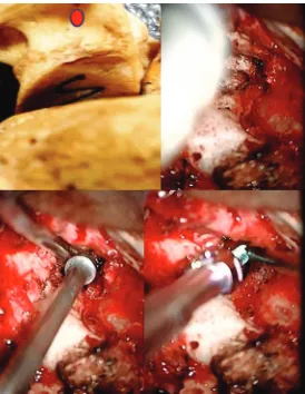 Figure 8: The cadaveric lateral masses are confirming cube shapes lateral masses, and their orientation is defined by the orientation of facet above and below