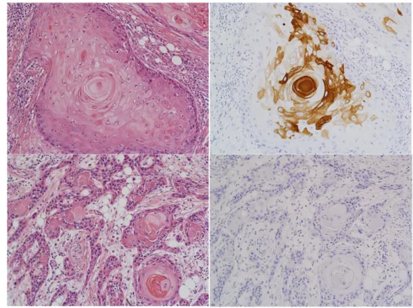 Figure 4: Relationship between CK4 protein expression, RFS and DSS.  (A) Micrograph of a representative TSCC expressing CK4  protein detected byimmunohistochemical staining