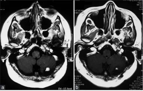 Figure 1: Axial gadolinium-enhanced magnetic resonance images of patient number 10 showing mural nodule with a small cyst (a)