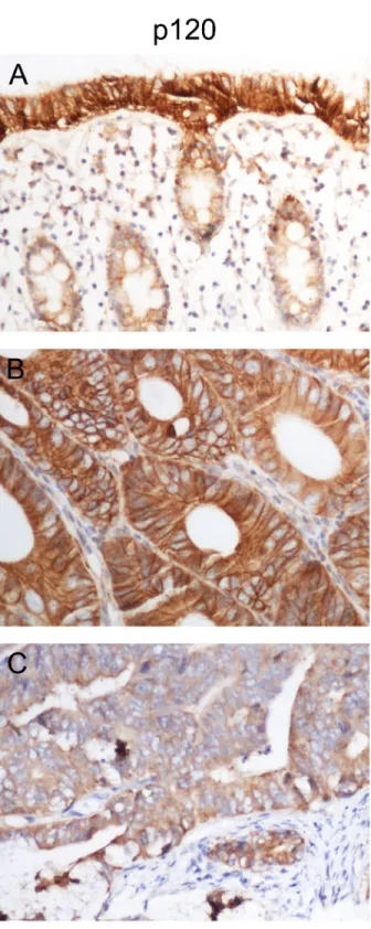 Figure 1: p120 is downregulated in human colon  cancer tissues.  IHC staining was performed in 80 colon cancer  tissues and 42 corresponding normal colon tissues