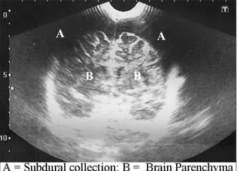 Figure 1: Transfontanellesonography of a child with bilateral subdural collection (annotated) 