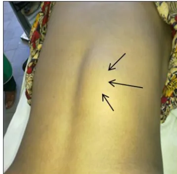 Figure 3: A magnetic resonance imaging scanT1W images A-coronal and B-axial section showed a huge mass involving the right para spinal area and spinal cannel at D11-L1, compressing the spinal cord (D11-D12) and destroyed the posterior arches of the vertebra (D12-L1)