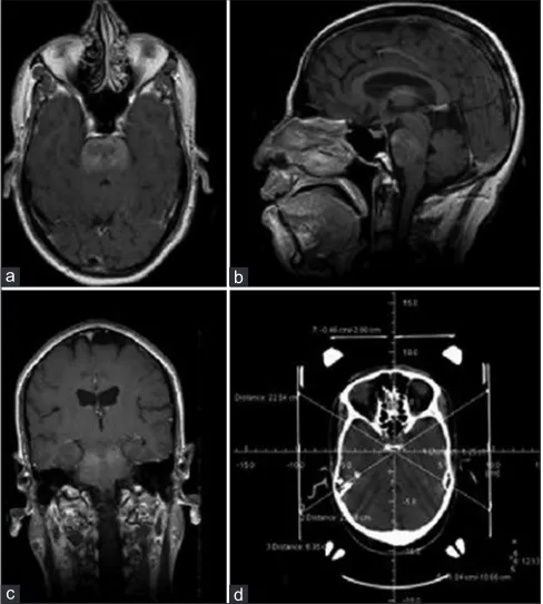 Figure 1: Postcontrast axial (a), sagittal (b) and coronal (c) MRI brain and CT brain with stereotactic frame showing the coordinates (d), of a 12-year-old boy with multiple cranial nerve involvement