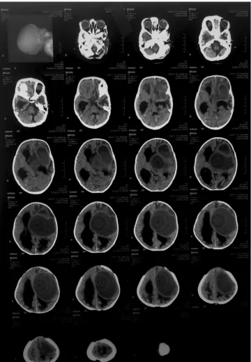 Figure 1: Pediatric brain CT-scan series showing a large hypodense lesion in left fronto-temporal region associated to mass effect and dilatation of ventricular system