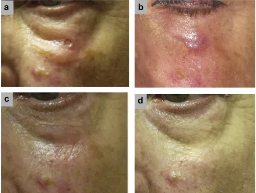 Fig. 3. A 68-year-old woman with squamous cell carcinoma below left eye treated with 10 mm surface applicator using 40 Gy to a 3-mm depth at (a) pretreatment, (b) 1 month, (c) 2.5 months, and (d) 20 months.