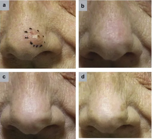Fig. 4. A 73-year-old woman with basal cell carcinoma on left tip of nose treated with 20 mm surface applicator using 40 Gy to a 3-mm depth at (a) pretreat- pretreat-ment, (b) 4 months, (c) 16 months, and (d) 23 months.
