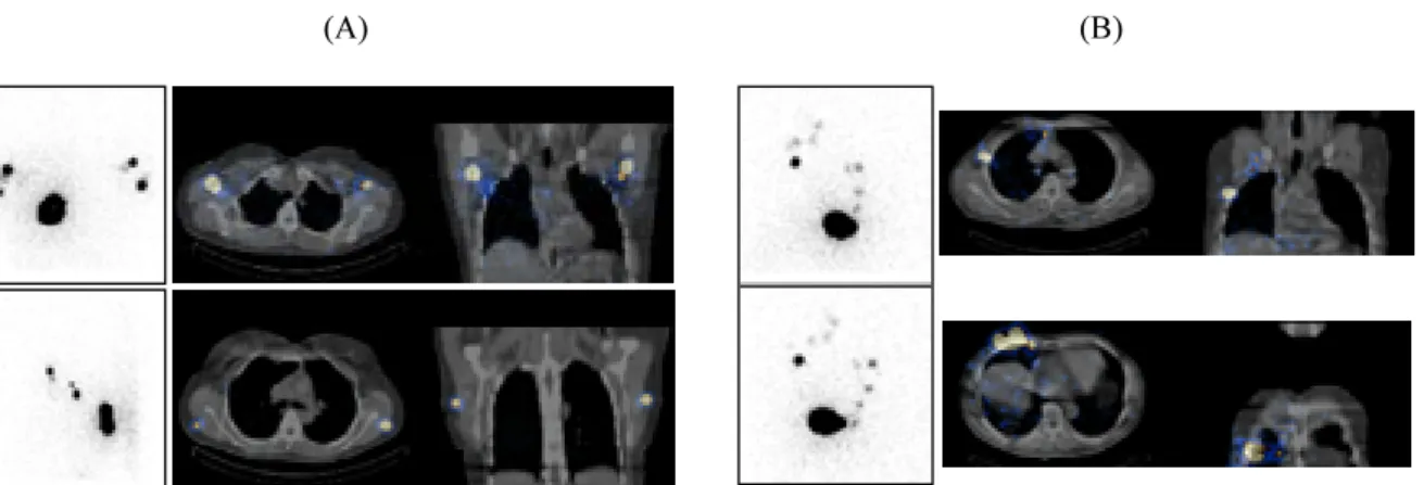 FIG. 6. Additional information over planar scintigraphy provided by SPECT/CT in two patients with  malignant cutaneous melanoma submitted to lymphoscintigraphy with  99m Tc-albumin nanocolloid  before radioguided sentinel lymph node biopsy