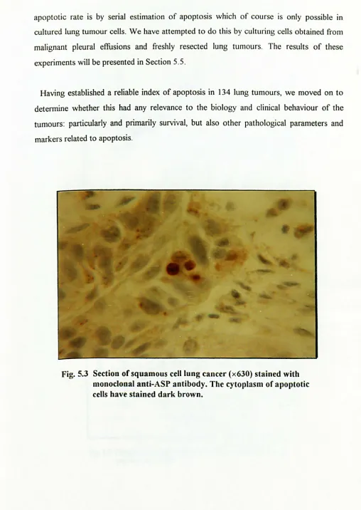 Fig. 5.3 Section of squamous cell lung cancer (x630) stained with monoclonal anti-ASP antibody