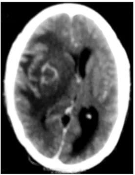 Figure 2: CECT brain showing multiple ring-enhancing lesions with edema in both cerebral hemispheres (Case 3)