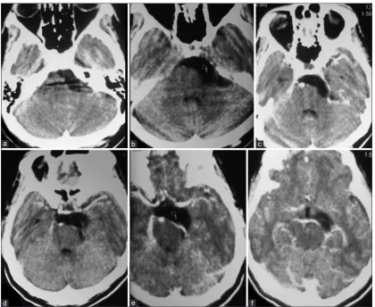Figure 1: Preoperative CT scan of brain serial axial sections (a-f) showing hypodence epidermoid tumor in left cerebello-pontine angle and prepontine area as well as supratentorial extension with displacement of brainstem