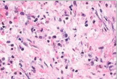 Figure 6: Histopathology of epidermoid: Microphotograph